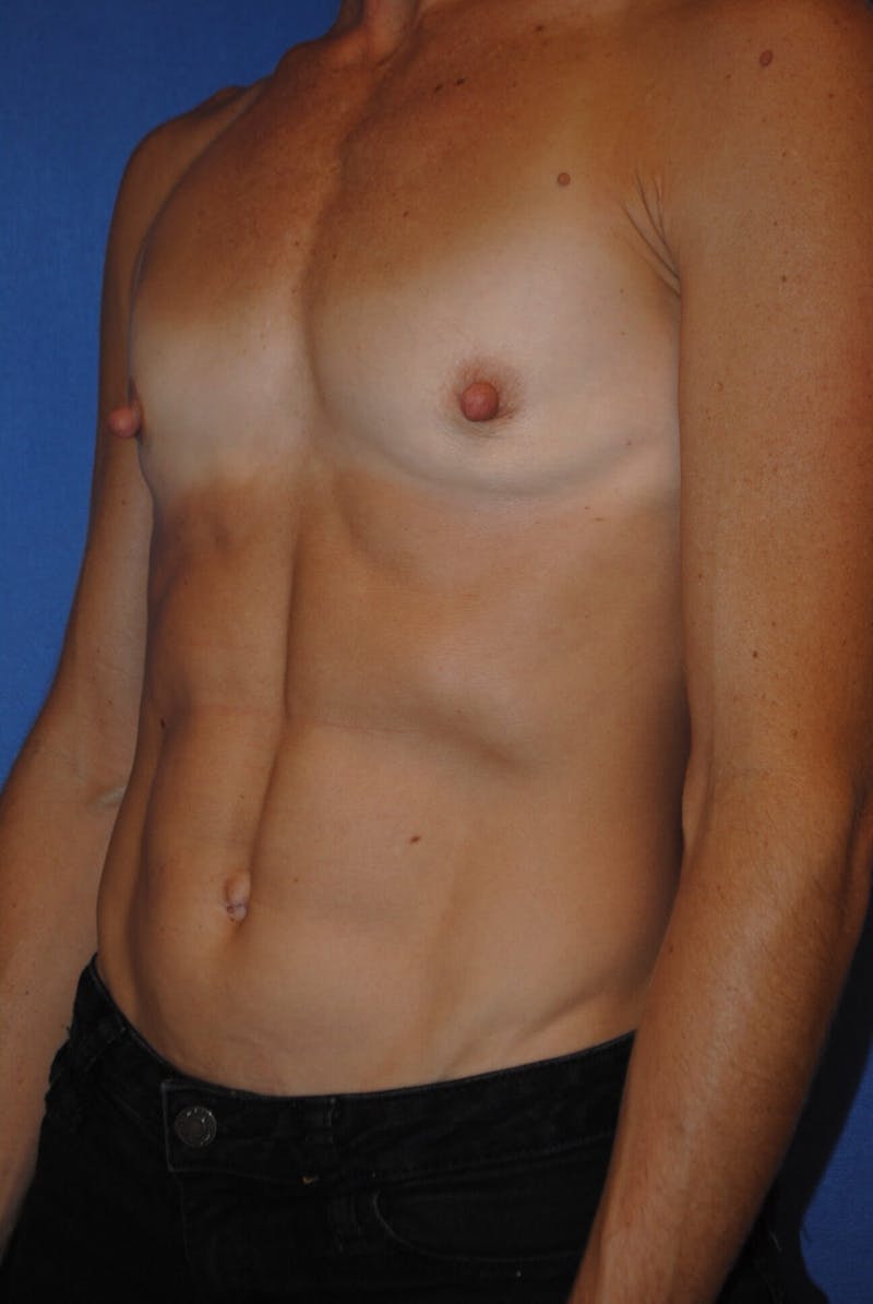 Breast Augmentation Before & After Gallery - Patient 90006254 - Image 3