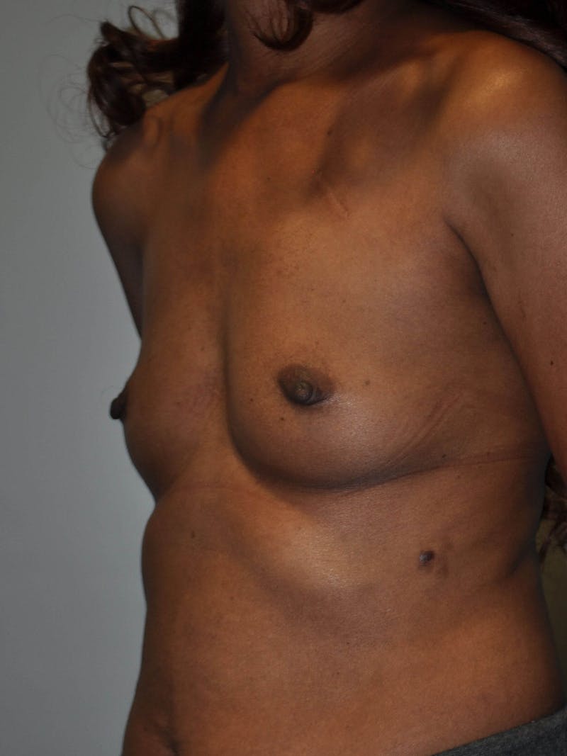 Breast Augmentation Before & After Gallery - Patient 90006258 - Image 3