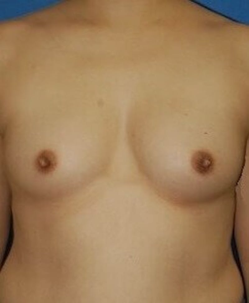 Breast Augmentation Before & After Gallery - Patient 90006259 - Image 1