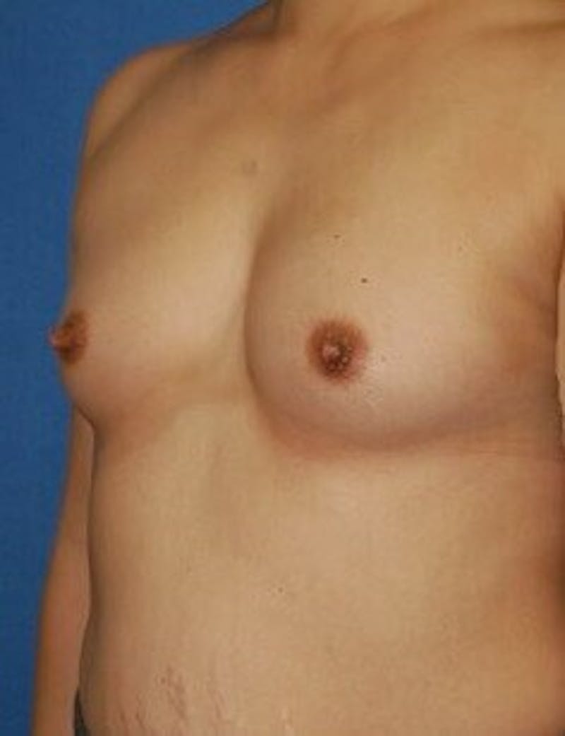 Breast Augmentation Before & After Gallery - Patient 90006259 - Image 3