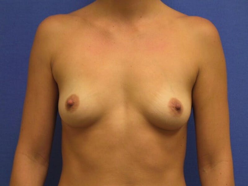 Breast Augmentation Before & After Gallery - Patient 90006263 - Image 1