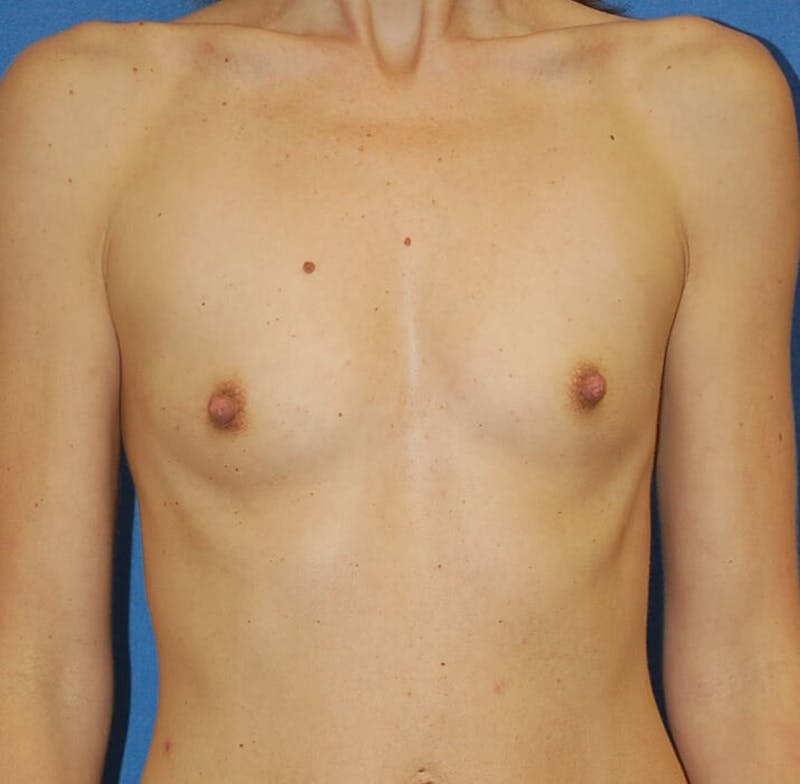 Breast Augmentation Before & After Gallery - Patient 90006418 - Image 1
