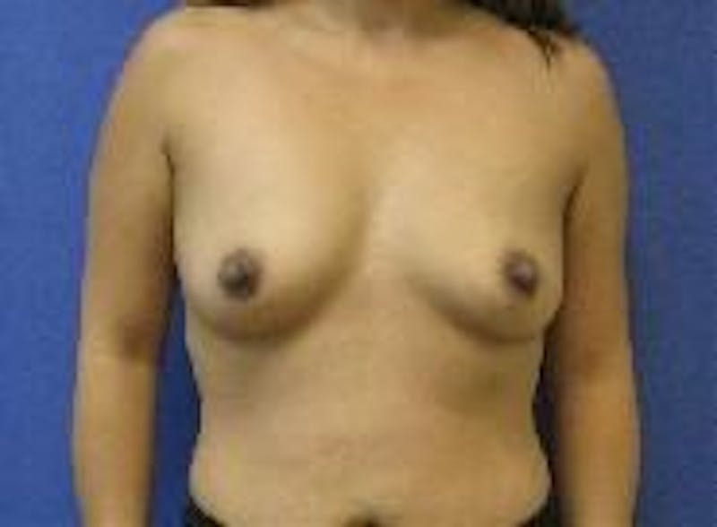 Breast Augmentation Before & After Gallery - Patient 90006419 - Image 1
