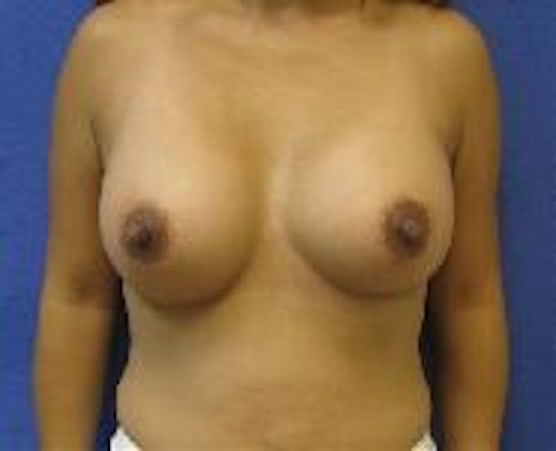 Breast Augmentation Before & After Gallery - Patient 90006419 - Image 2