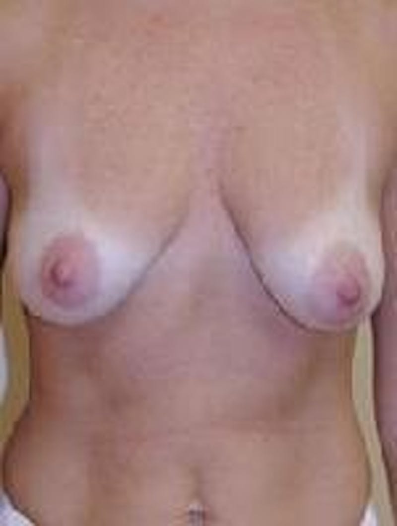Breast Augmentation Before & After Gallery - Patient 90006420 - Image 1