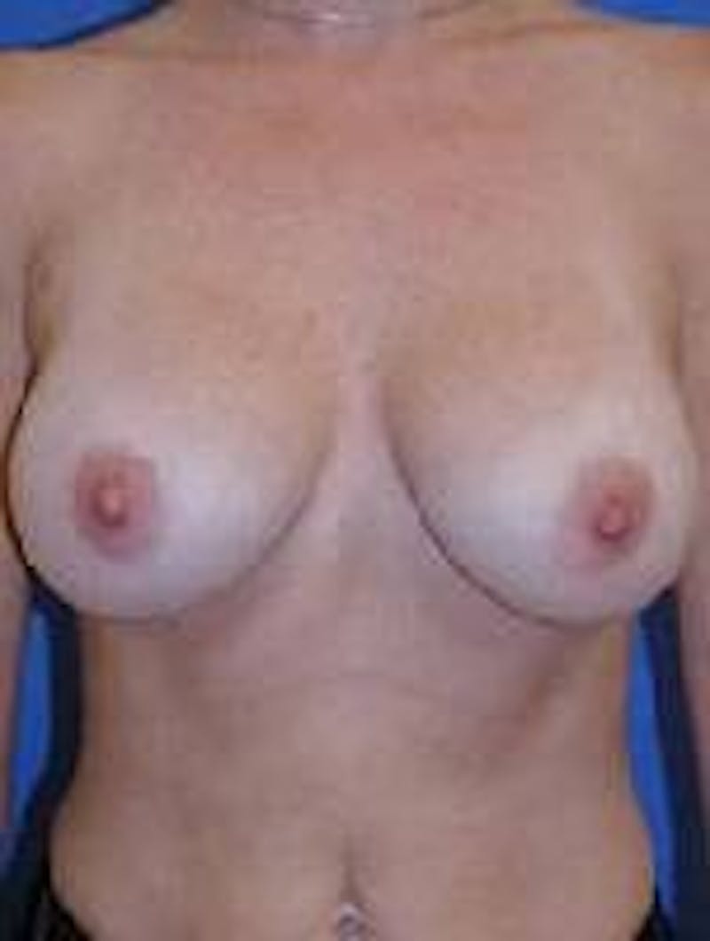 Breast Augmentation Before & After Gallery - Patient 90006420 - Image 2