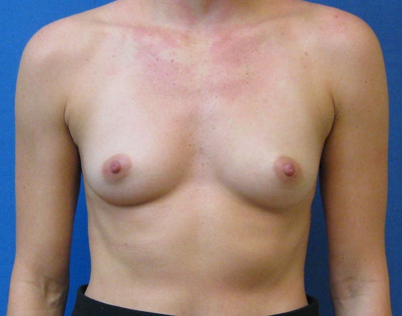 Breast Augmentation Before & After Gallery - Patient 90006421 - Image 1