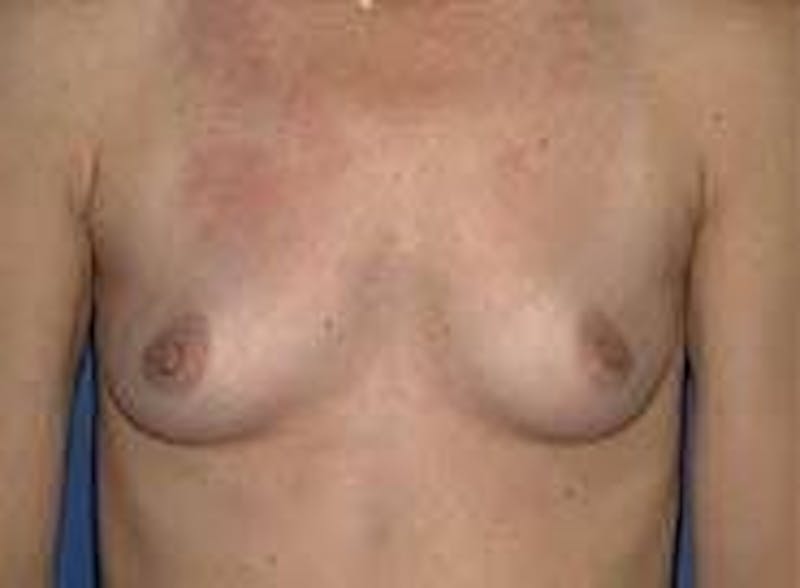 Breast Augmentation Before & After Gallery - Patient 90006422 - Image 1