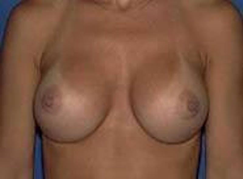 Breast Augmentation Before & After Gallery - Patient 90006422 - Image 2