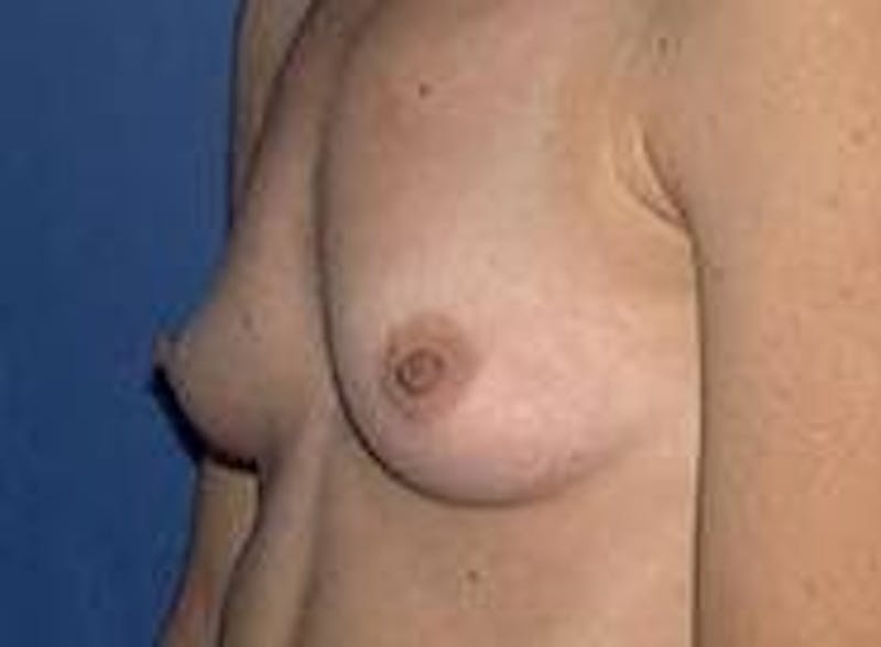 Breast Augmentation Before & After Gallery - Patient 90006422 - Image 3