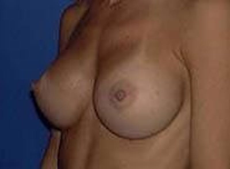 Breast Augmentation Before & After Gallery - Patient 90006422 - Image 4