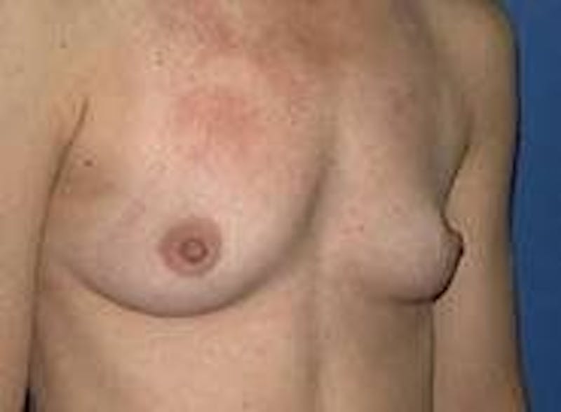 Breast Augmentation Before & After Gallery - Patient 90006422 - Image 5