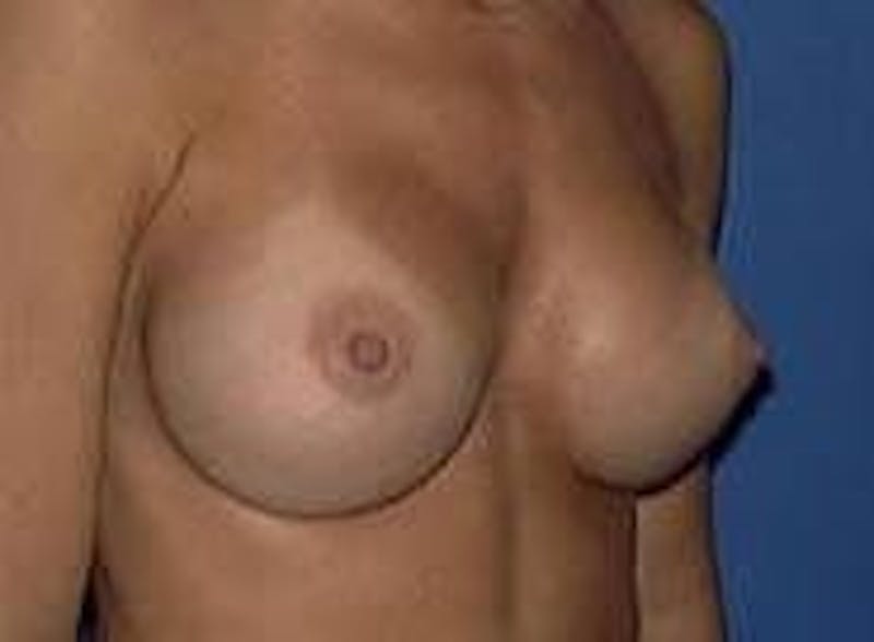 Breast Augmentation Before & After Gallery - Patient 90006422 - Image 6