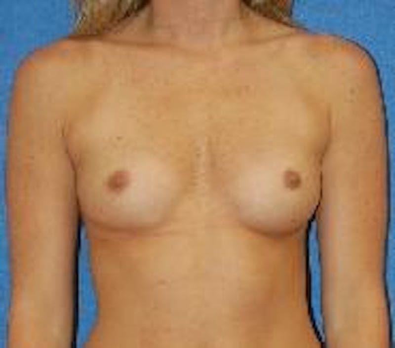 Breast Augmentation Before & After Gallery - Patient 90006423 - Image 1