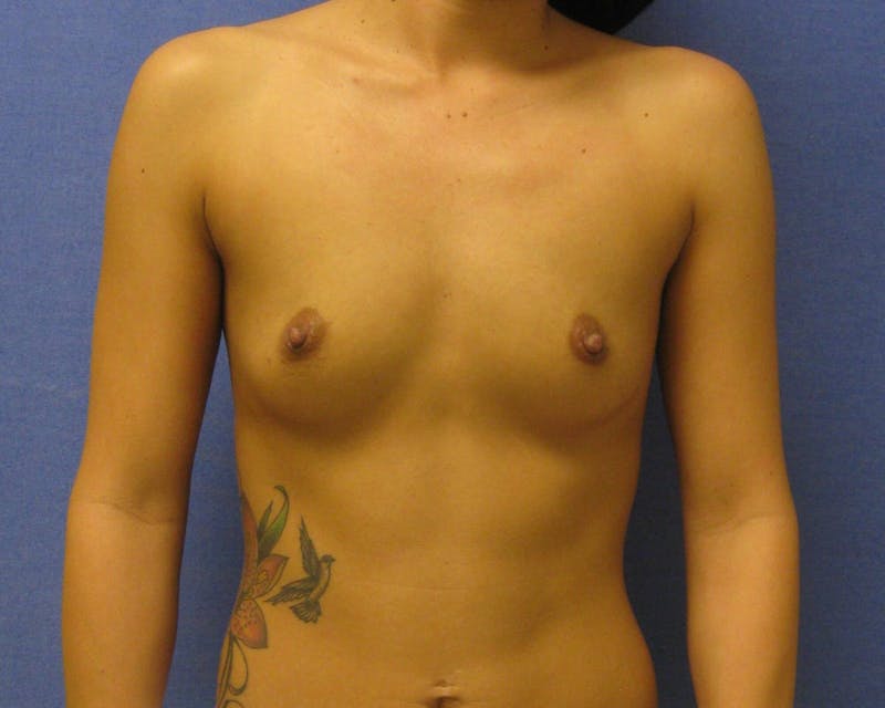 Breast Augmentation Before & After Gallery - Patient 90006424 - Image 1