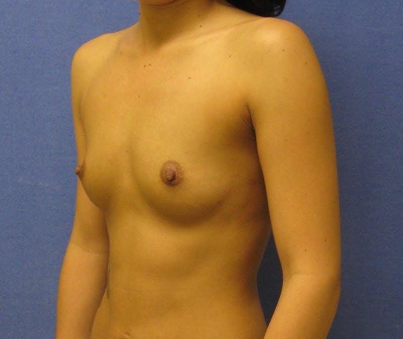 Breast Augmentation Before & After Gallery - Patient 90006424 - Image 3