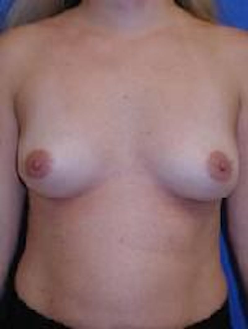 Breast Augmentation Before & After Gallery - Patient 90006425 - Image 1