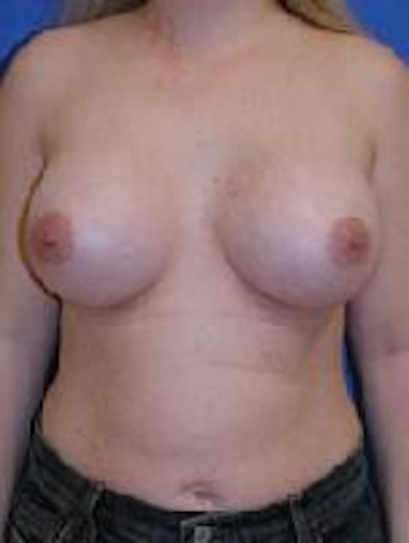 Breast Augmentation Before & After Gallery - Patient 90006425 - Image 2