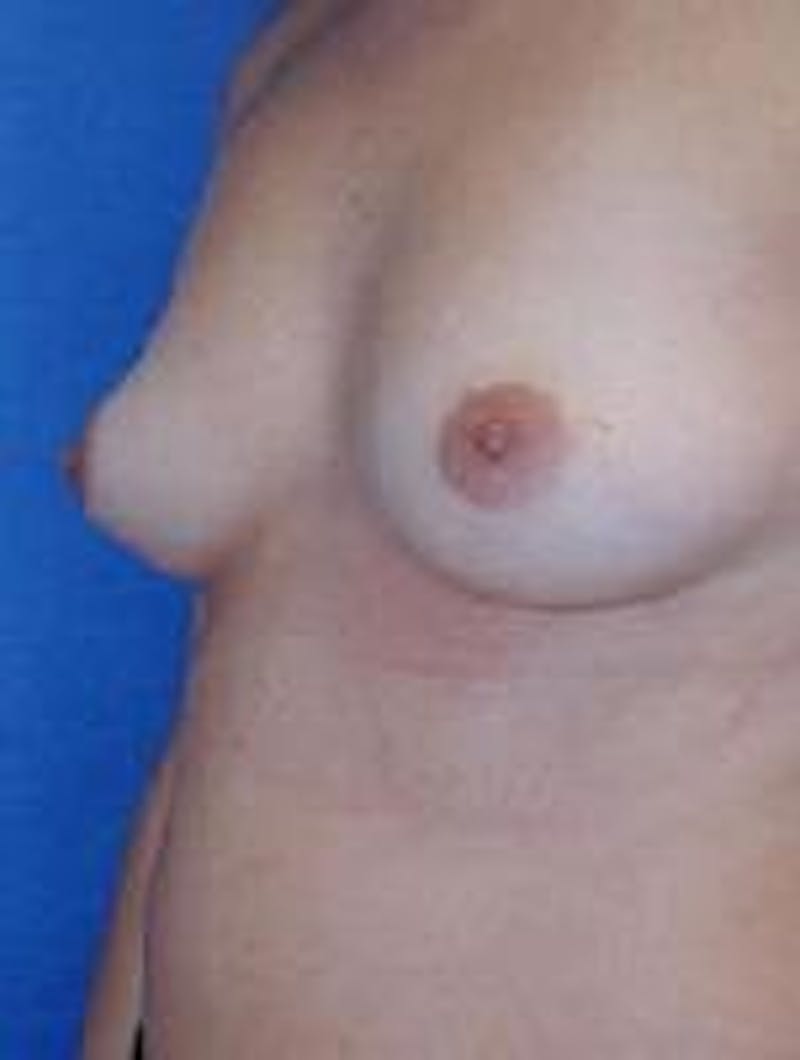 Breast Augmentation Before & After Gallery - Patient 90006425 - Image 3