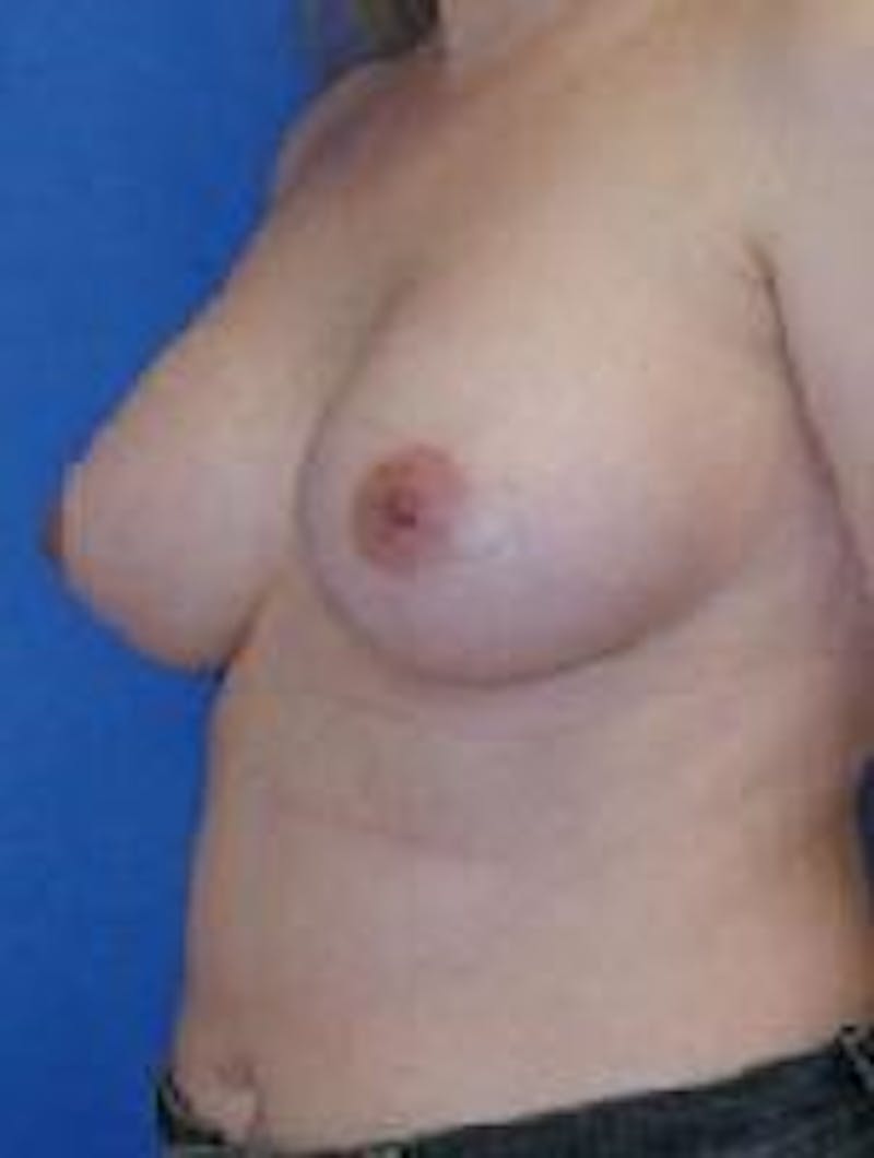 Breast Augmentation Before & After Gallery - Patient 90006425 - Image 4