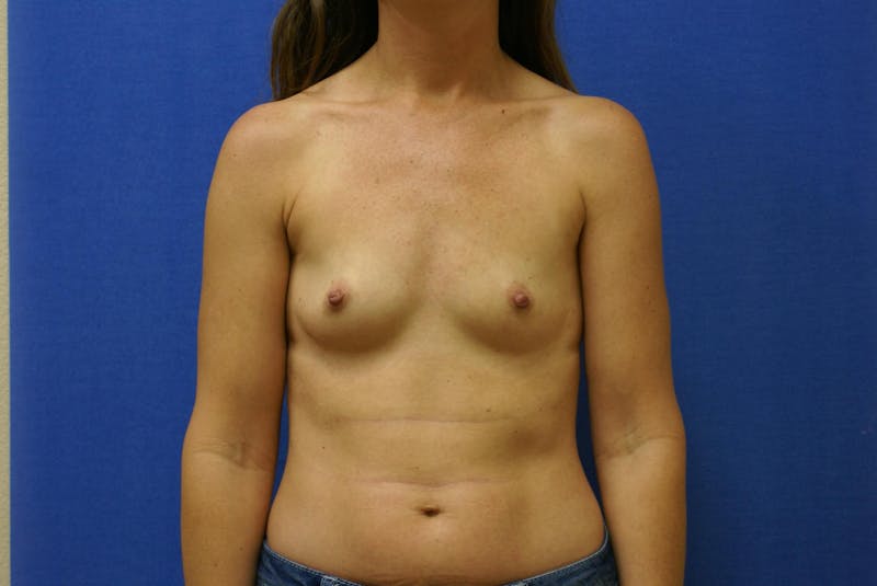 Breast Augmentation Before & After Gallery - Patient 90006450 - Image 1