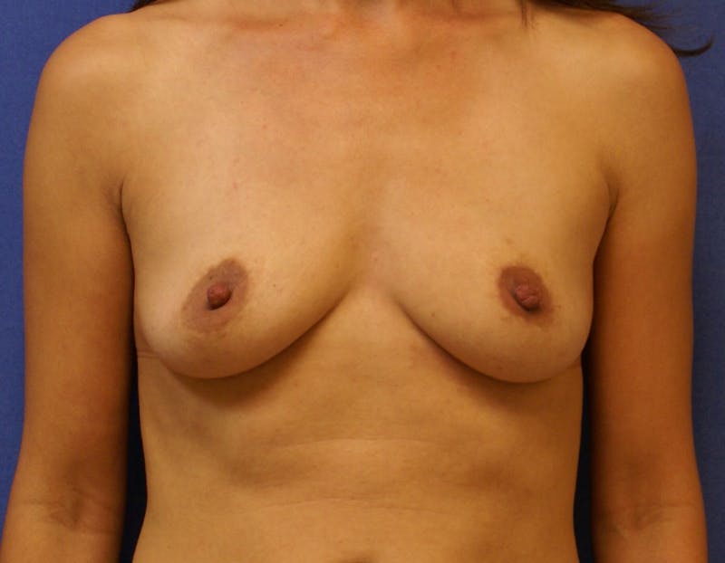Breast Augmentation Before & After Gallery - Patient 90006525 - Image 1