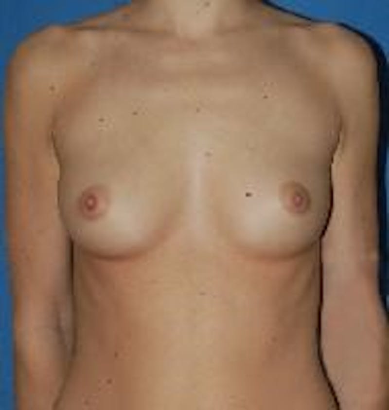 Breast Augmentation Before & After Gallery - Patient 90006528 - Image 1