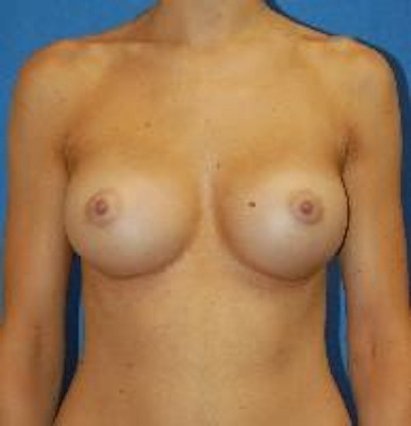 Breast Augmentation Before & After Gallery - Patient 90006528 - Image 2