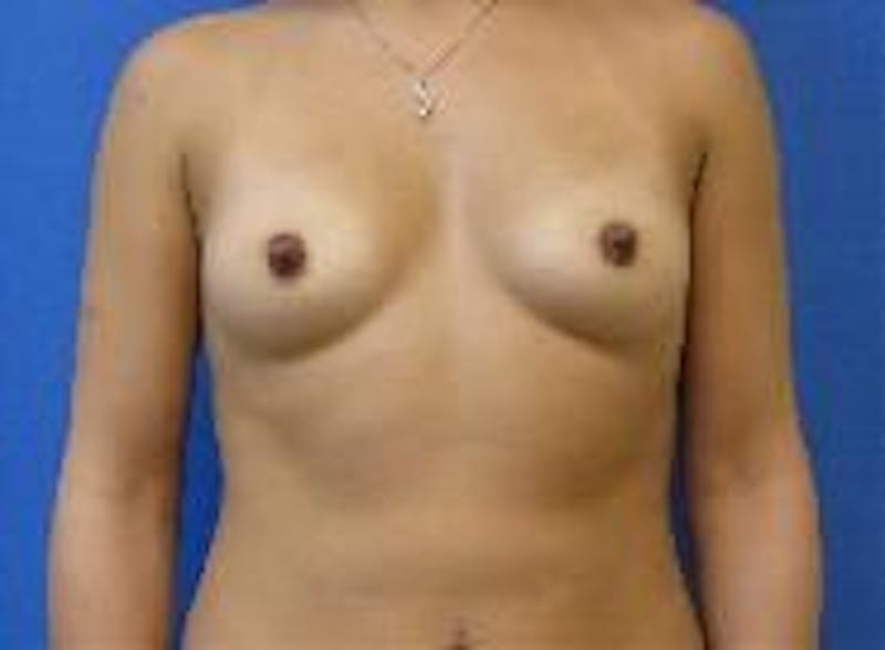 Breast Augmentation Before & After Gallery - Patient 90006530 - Image 1