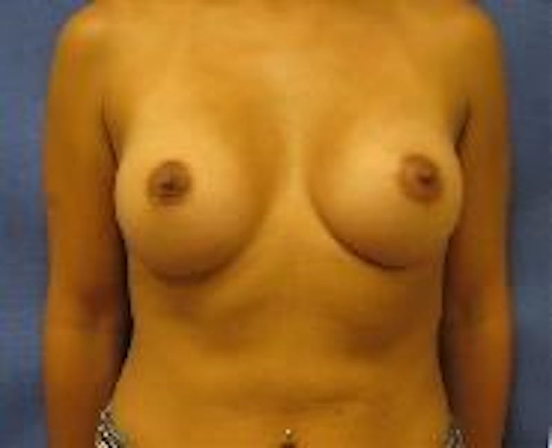 Breast Augmentation Before & After Gallery - Patient 90006530 - Image 2