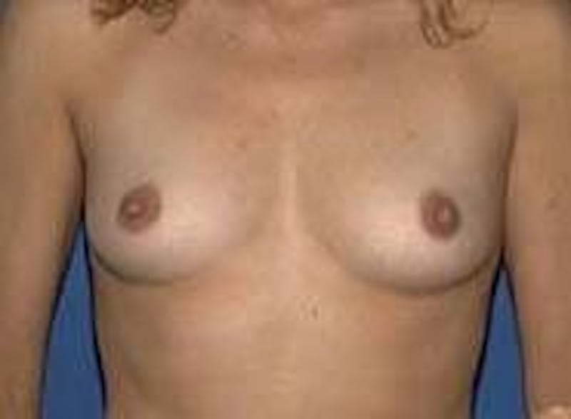 Breast Augmentation Before & After Gallery - Patient 90006532 - Image 1
