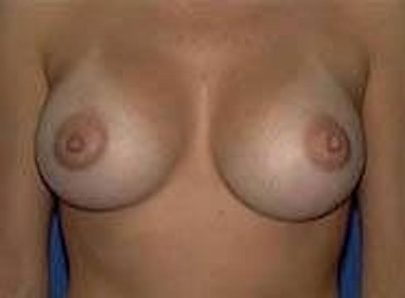 Breast Augmentation Before & After Gallery - Patient 90006532 - Image 2
