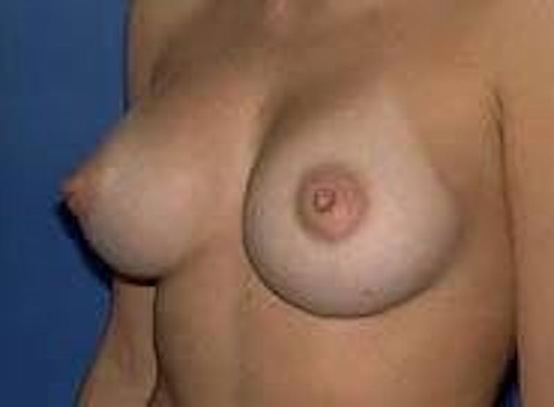 Breast Augmentation Before & After Gallery - Patient 90006532 - Image 4