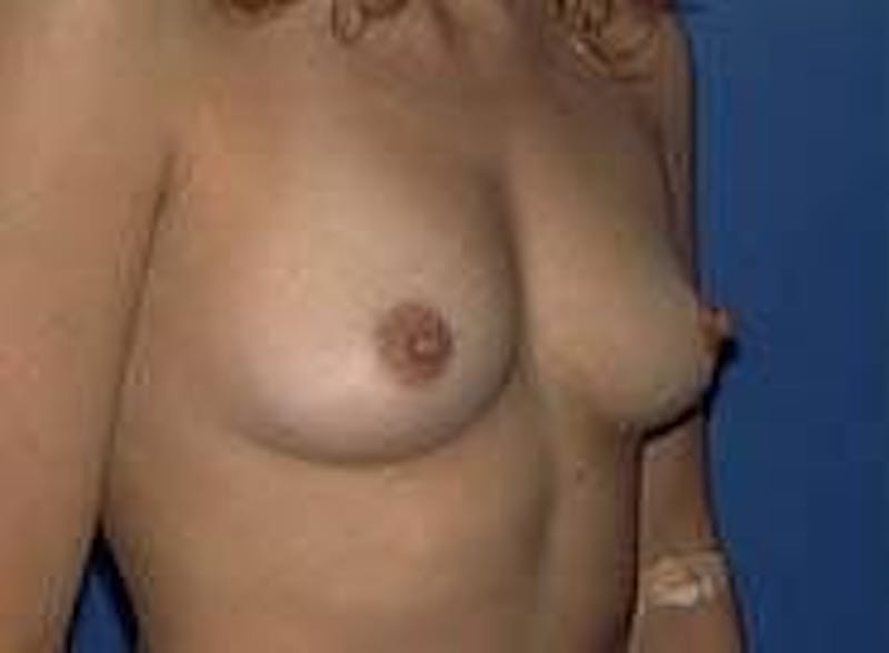 Breast Augmentation Before & After Gallery - Patient 90006532 - Image 5