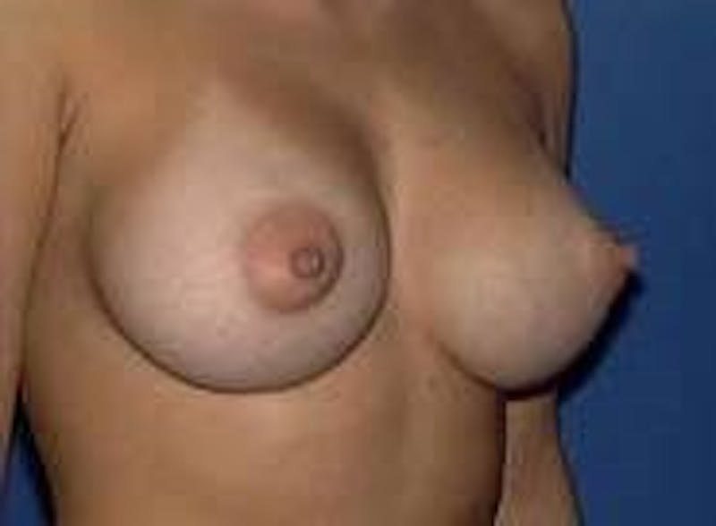 Breast Augmentation Before & After Gallery - Patient 90006532 - Image 6