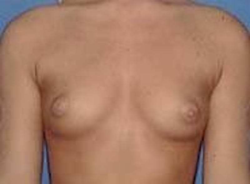 Breast Augmentation Before & After Gallery - Patient 90006533 - Image 1