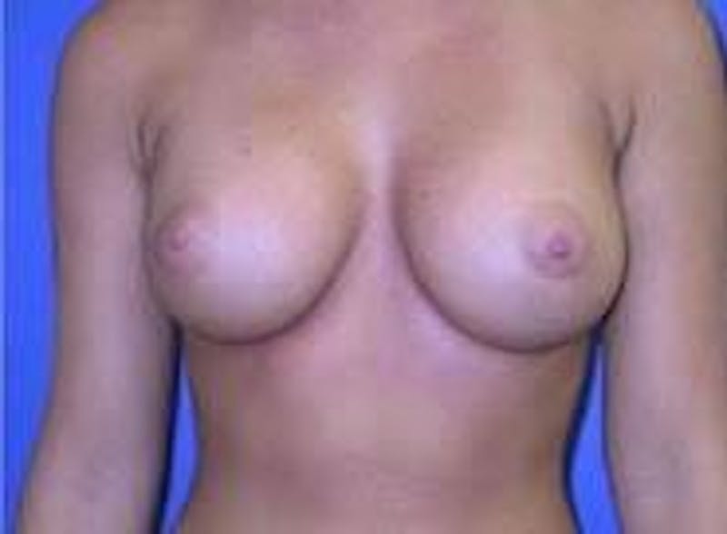 Breast Augmentation Before & After Gallery - Patient 90006533 - Image 2