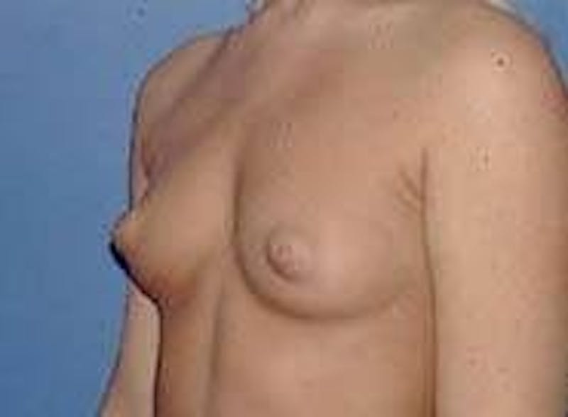 Breast Augmentation Before & After Gallery - Patient 90006533 - Image 3