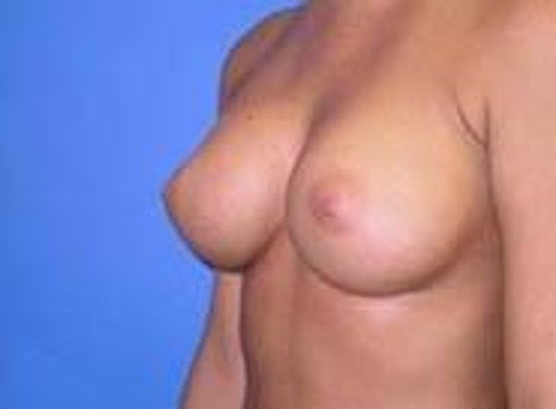 Breast Augmentation Before & After Gallery - Patient 90006533 - Image 4