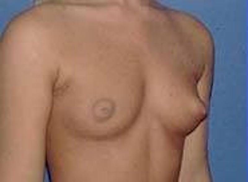Breast Augmentation Before & After Gallery - Patient 90006533 - Image 5