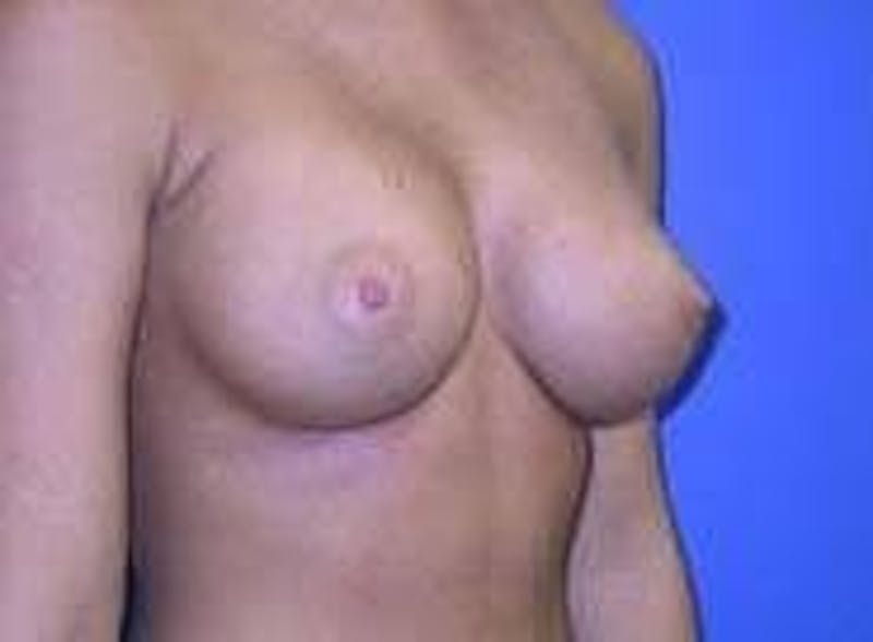 Breast Augmentation Before & After Gallery - Patient 90006533 - Image 6