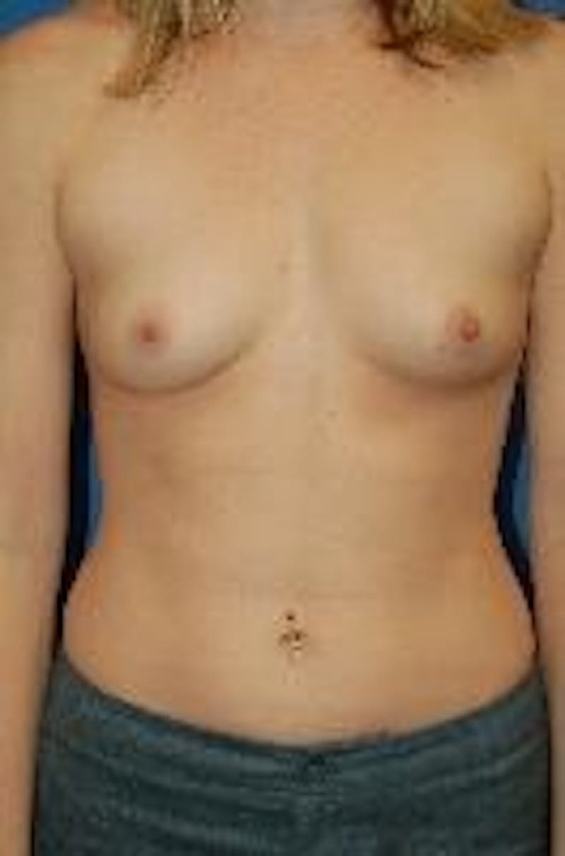 Breast Augmentation Before & After Gallery - Patient 90006534 - Image 1
