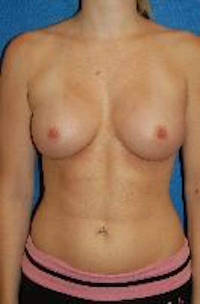 Breast Augmentation Before & After Gallery - Patient 90006534 - Image 2