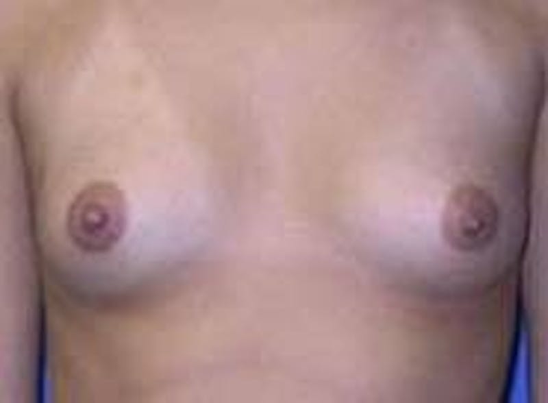 Breast Augmentation Before & After Gallery - Patient 90006535 - Image 1