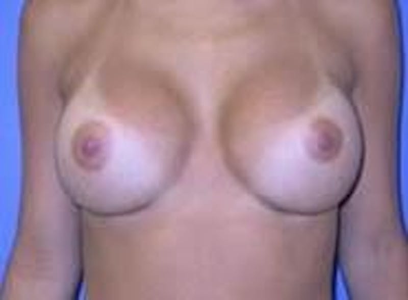 Breast Augmentation Before & After Gallery - Patient 90006535 - Image 2