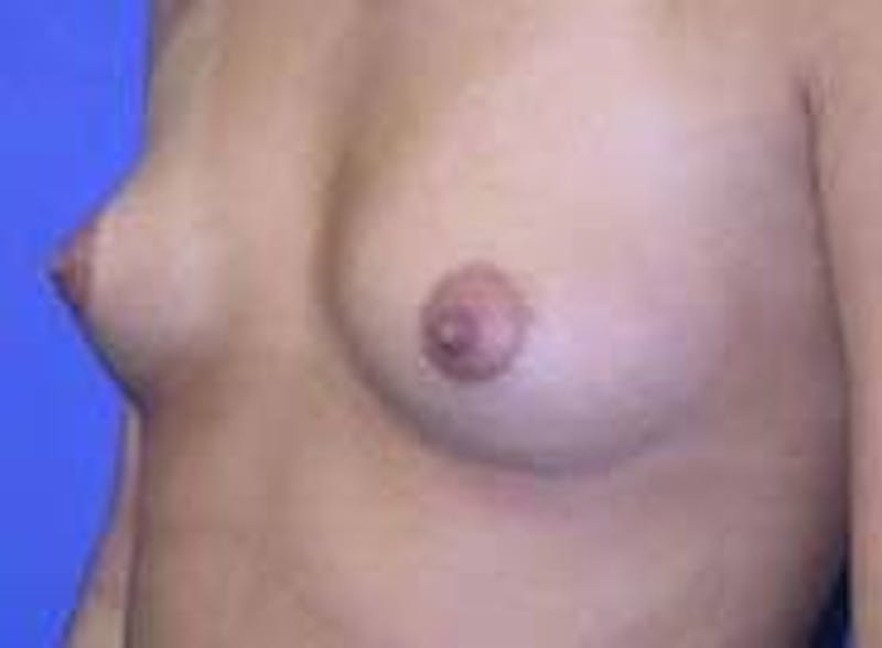 Breast Augmentation Before & After Gallery - Patient 90006535 - Image 3