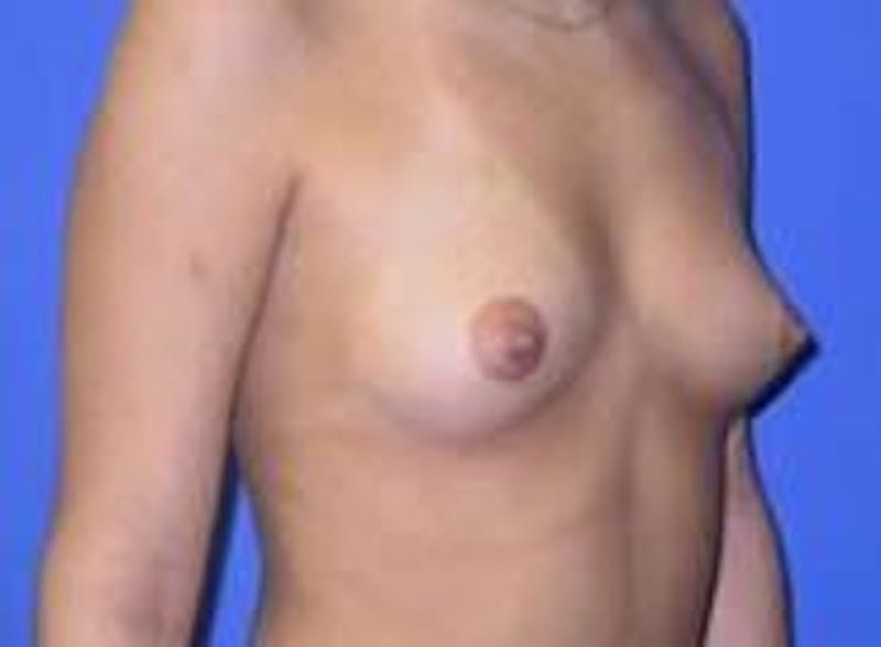 Breast Augmentation Before & After Gallery - Patient 90006535 - Image 5