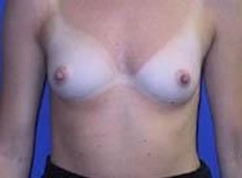 Breast Augmentation Before & After Gallery - Patient 90006536 - Image 1