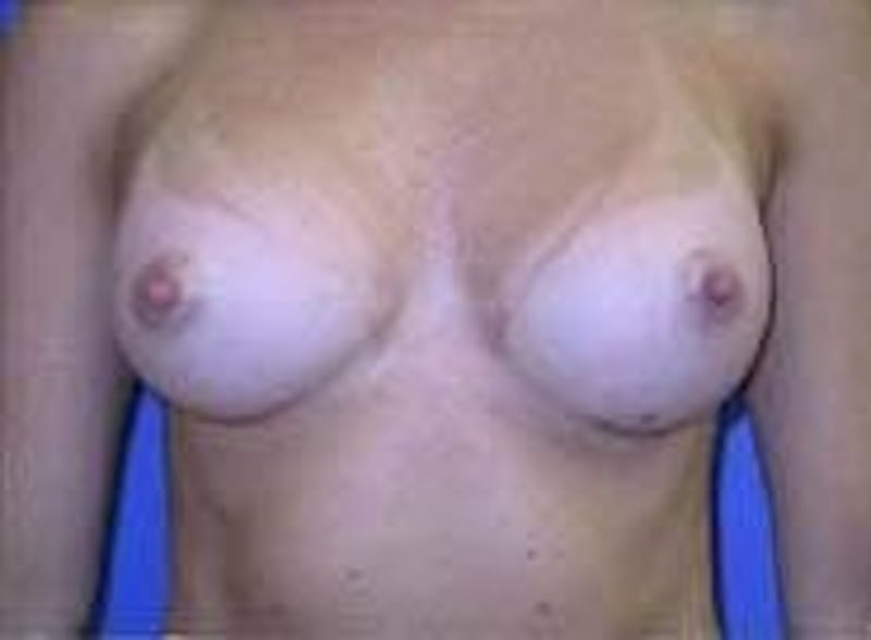 Breast Augmentation Before & After Gallery - Patient 90006536 - Image 2