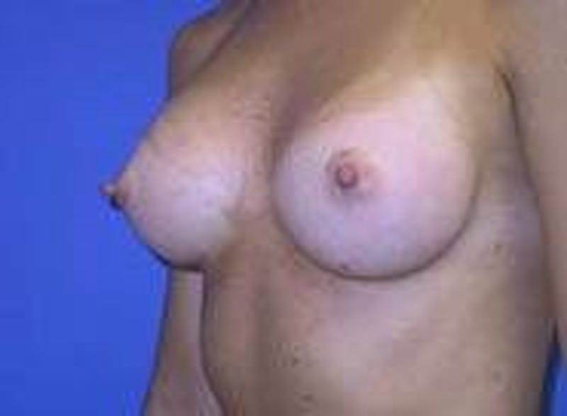 Breast Augmentation Before & After Gallery - Patient 90006536 - Image 4